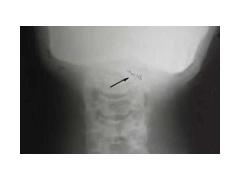 How To Neutralize Implants How To Neutralize Implants