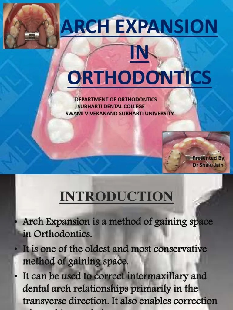 Arch Expansion. | PDF