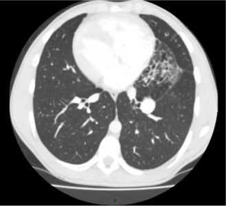CTC Scan Lungs CTC Scan Lungs
