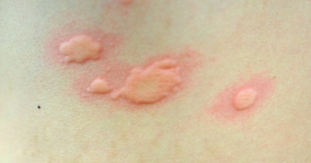 寒冷性蕁麻疹 その癢み 寒さが原因かも Liudong