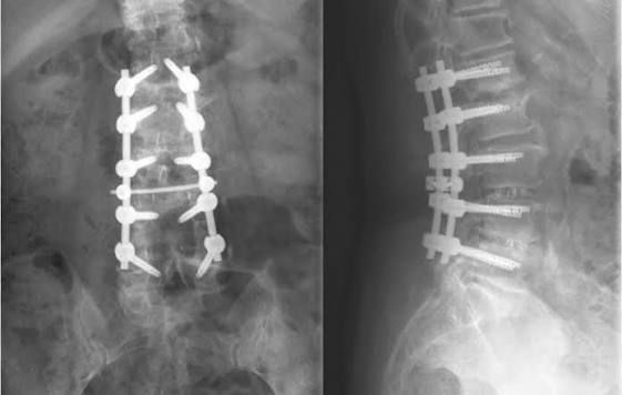 هل يجب إزالة مسامير العمود الفقري بعد تثبيتها جراحيًا؟