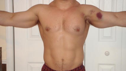 Pec Tear - Pectoralis Major Tears/Rupture | 321GOMD
