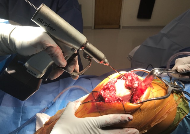 All About Patellar Quadriceps Tendon Tears 321GOMD