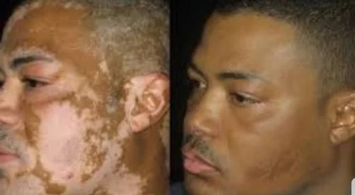 Female Medical Tattoo For Scars Vitiligo Burns Scalp Eyebrow Id 18235845888
