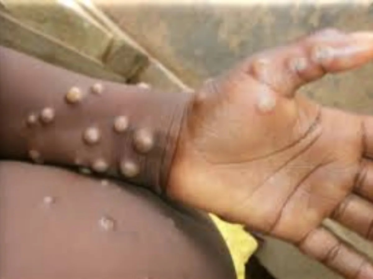 Monkeypox खतरनाक बीमारी है, जानिए इसके लक्षण और बचाव के उपाय