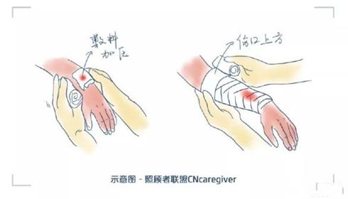 images 止血 方法 http www sohu com a 313199528 100196307