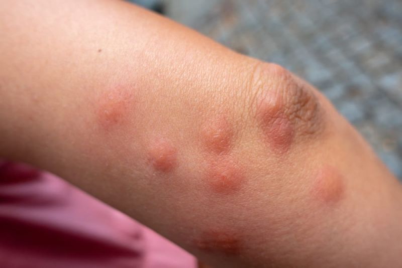 pests bite
