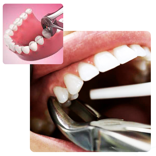Tooth Extraction
