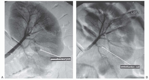 Diagnostic Angiography and Therapeutic Endovascular Intervention of the ...