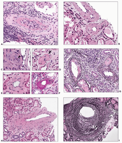 Primer on the Pathologic Classification and Diagnosis of Kidney Disease ...