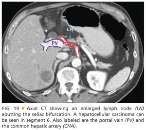 Surgical Anatomy of the Liver | Abdominal Key