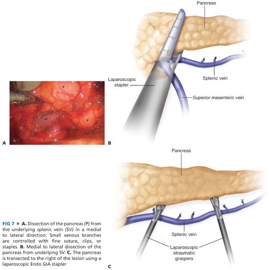 Distal Pancreatectomy with Splenic Preservation Abdominal Key