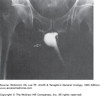Injuries to the Genitourinary Tract | Abdominal Key