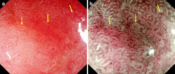 Clinical Applications of Magnifying Endoscopy with Narrow-Band Imaging ...