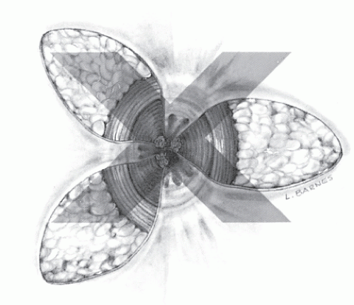 Hemorrhoids | Abdominal Key