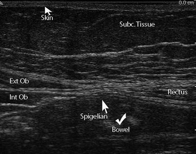 Left sagittal ultrasound through the left side of the abdomen shows the descending colon represented by arcs of echogenicity with posterior reverberation . Abdominal Wall Anatomy Pathology And Intervention Abdominal Key