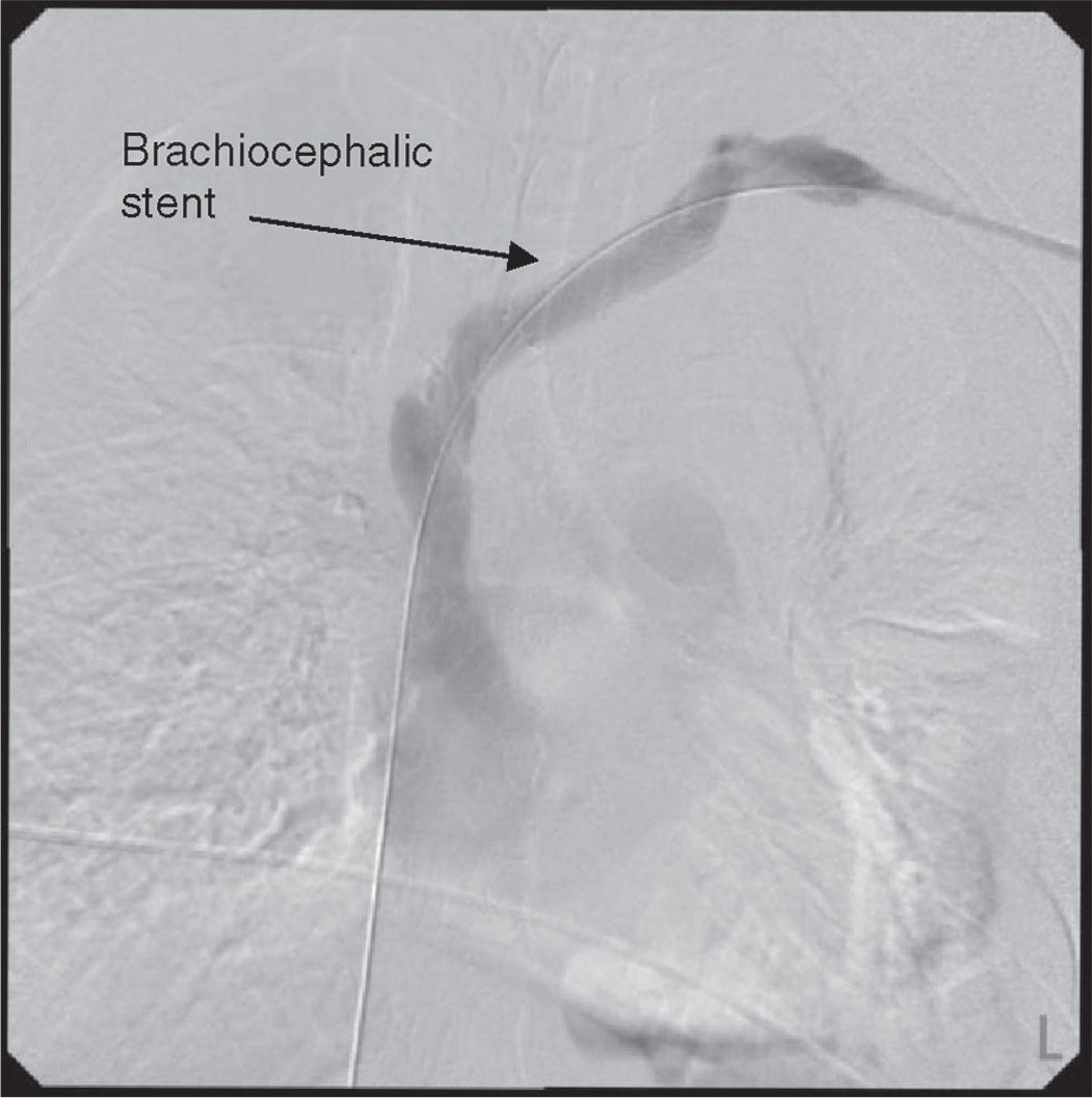 Venous Catheter Infections and Other Complications Abdominal Key