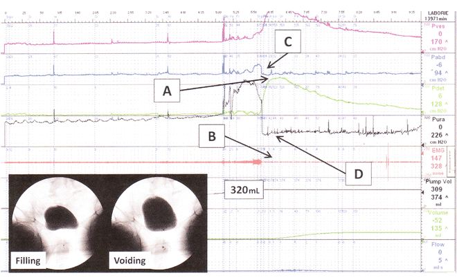 Urodynamic Assessment | Abdominal Key