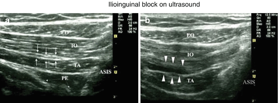 Ilioinguinal and Genitofemoral Neuralgia | Abdominal Key