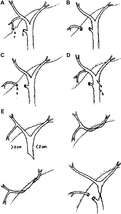 Image showcasing Treatment of Common Bile Duct Injuries After Surgery | Abdominal Key