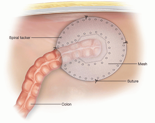 Robotic Rectopexy | Abdominal Key