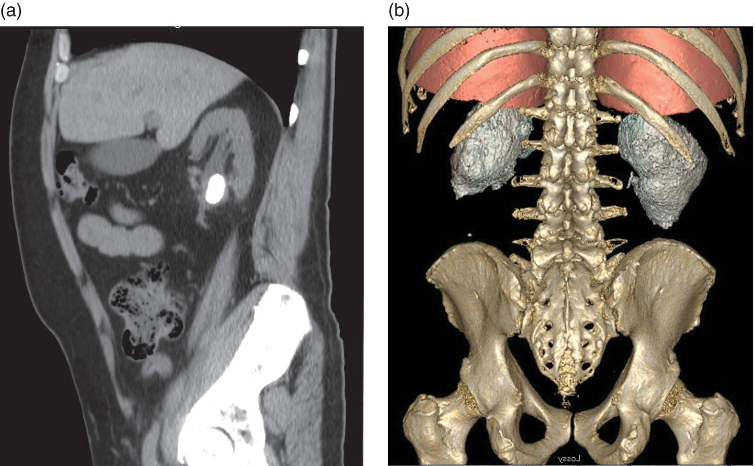 Diagnosis and Management of Thoracic Complications of Percutaneous