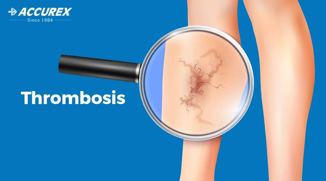 Thrombosis