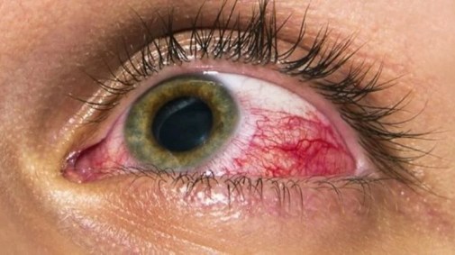 Los Riesgos de las Extensiones de Pestañas: Desde la Erosión de la Córnea Hasta el Pegamento Cancerígeno 4 Irritación ocular severa
