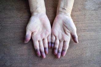 ¿Qué es la cianosis? Descubre las 10 enfermedades más peligrosas que la causan