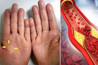 ¿Colesterol elevado? 10 hábitos diarios que elevan tu colesterol sin que lo sepas