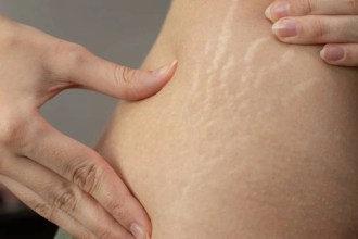 ¿Por qué salen estrías? Top 10 causas comunes que debes conocer para cuidar tu piel
