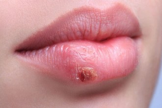 Top 10 Datos Científicos sobre la Transmisión del Herpes y Cómo Prevenir su Contagio Efectivamente