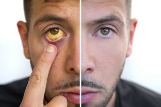 ¿Qué es la ictericia? 10 claves médicas para entender por qué se pone amarilla la piel