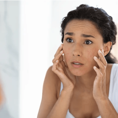 Eczema cutaneo e calcare