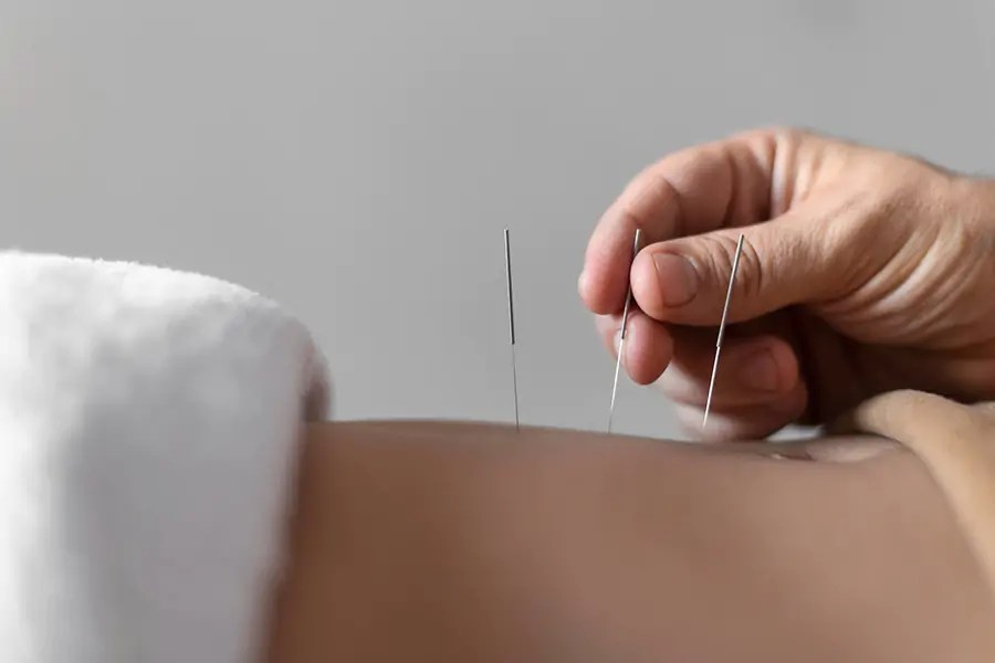 Acupuncture as Physiotherapy Treatment