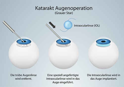 Der augenarzt operiert unter örtlicher betäubung und unter verwendung von ultraschall oder . Grauer Star - Afidera