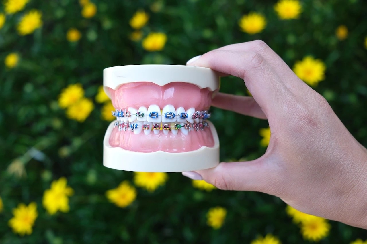 Traditional Metal Braces for kids, teens, and adults in Cupertino, Fremont, and Milpitas