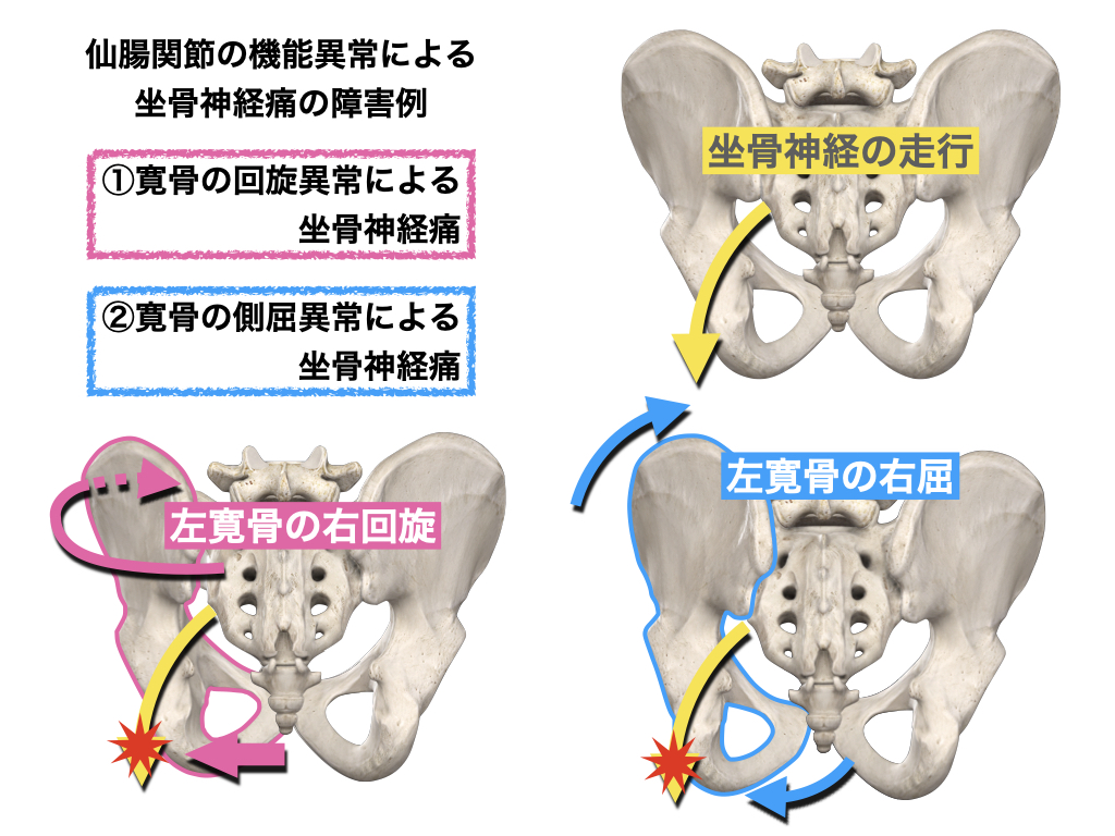 デスクワークと坐骨神経痛 仙腸関節と坐骨の歪み にしむら治療院 デスクワークと坐骨神経痛 仙腸関節と坐骨の歪み にしむら治療院