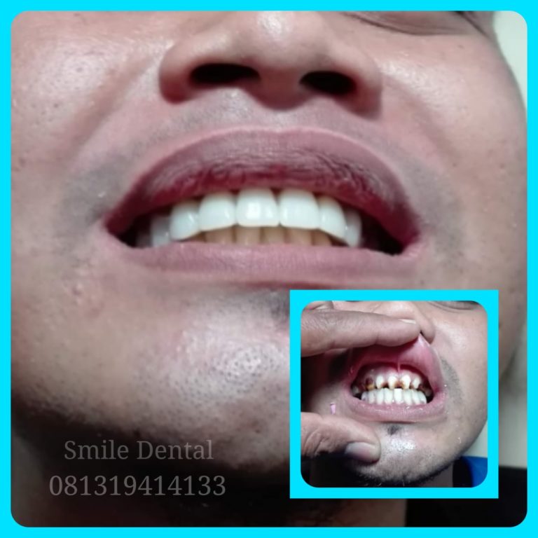 Cara mengatasi gigi keropos