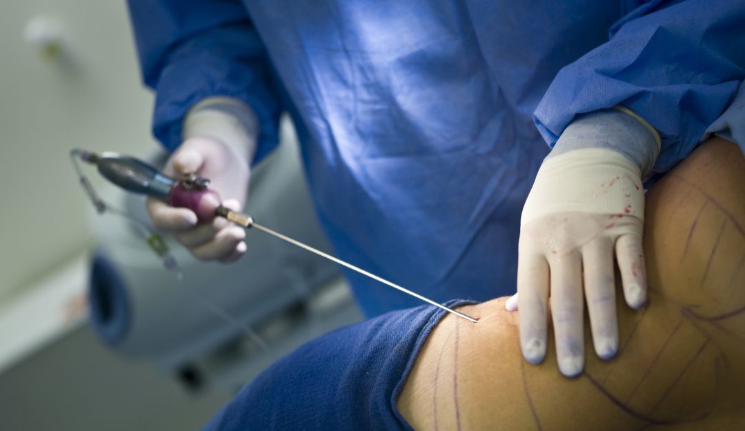 Se sometió a una lipoescultura y la dejaron en terapia intensiva