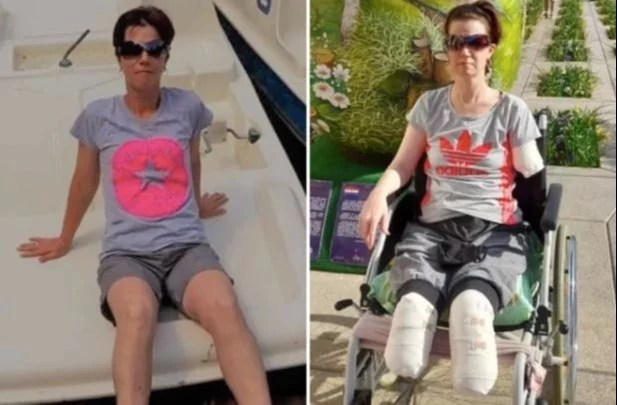 Va al hospital por un dolor de estómago y le amputan las piernas y un brazo