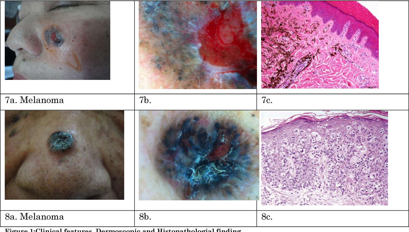 Figure 1 from clinical and dermoscopic features of skin cancer at sanglah general hospital