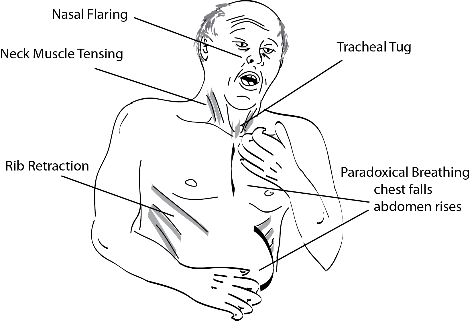 Recognizing Airway Obstruction May Save Your Patient's Life