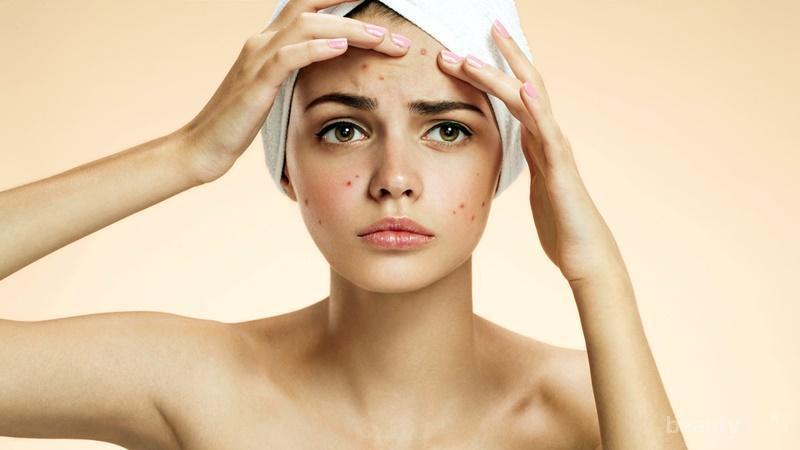 Sebenarnya blind pimple bisa disamakan dengan inflammatory acne, yaitu jerawat yang meradang tetapi tidak mengeluarkan nanah. Jangan Asal Pencet Ini Cara Ampuh Menghilangkan Jerawat Bisul Di Wajah
