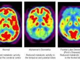 Pet Scan Brain