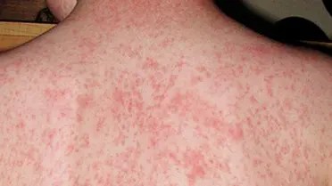 ارتفاع عدد الإصابات ببوحمرون في المؤسسات السجنية