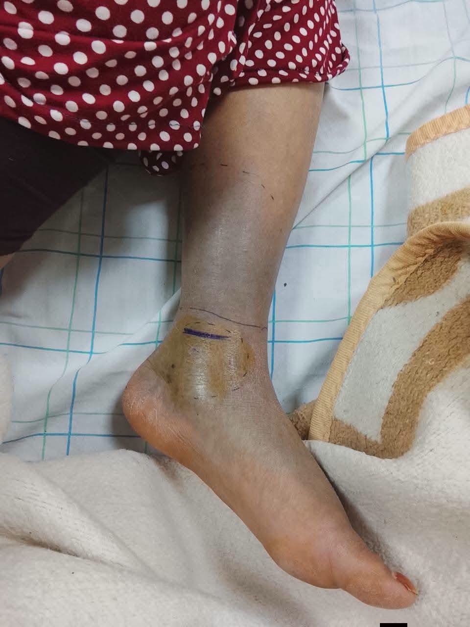 لدغة أفعى بدوار إكضي بطاطا.. نقل سيدة في حالة حرجة إلى المستشفى العسكري بكلميم