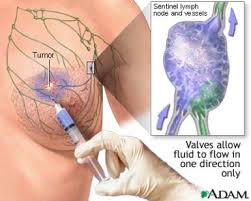 When to code Sentinel Injection code 38792 and Lymphoscintigraphy 78195