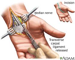 Simple Coding tips for Carpal tunnel syndrome