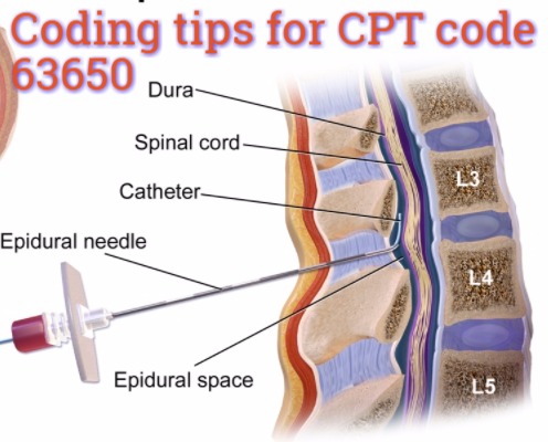 Best Coding tips for CPT code 63650